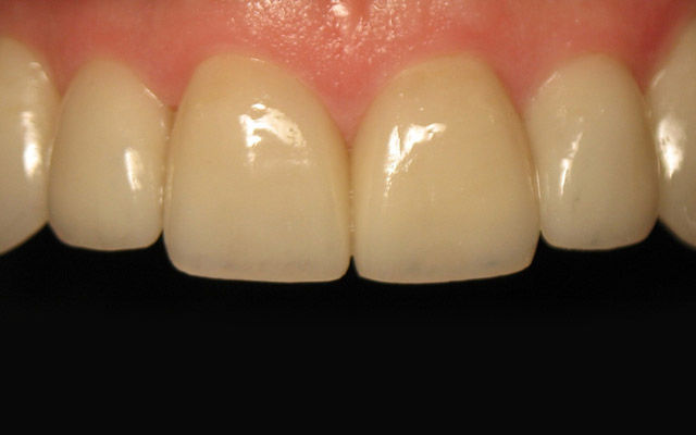 After photo: Porcelain veneers
