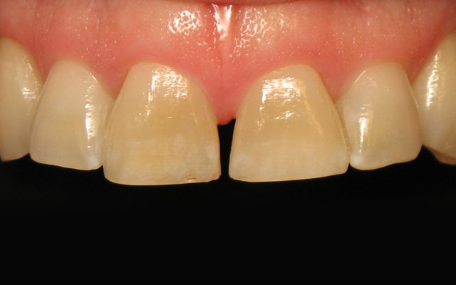 Before photo: Porcelain veneers