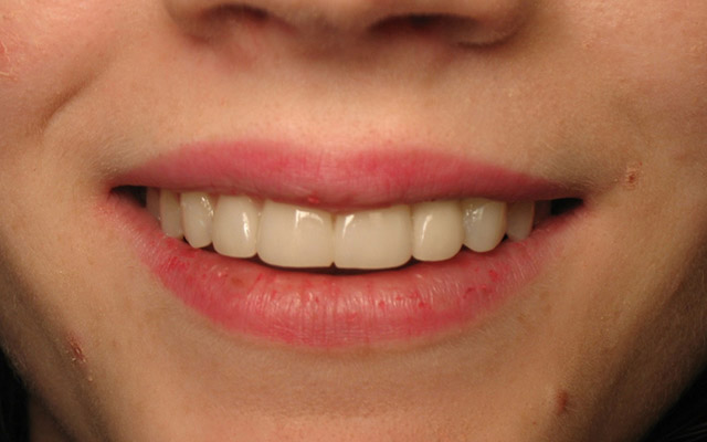 After photo: Dental Implant & porcelain veneers