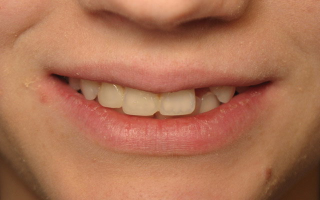 Before photo: Dental Implant & porcelain veneers