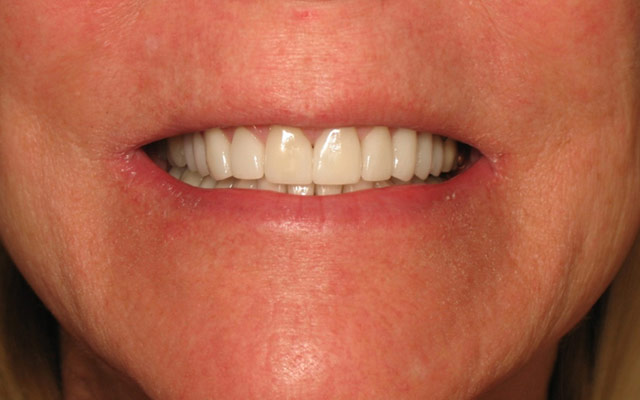 After photo: Porcelain veneers