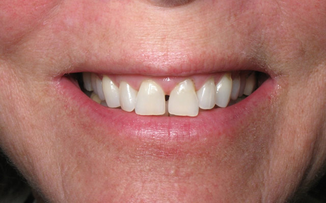 Before photo: Porcelain veneers