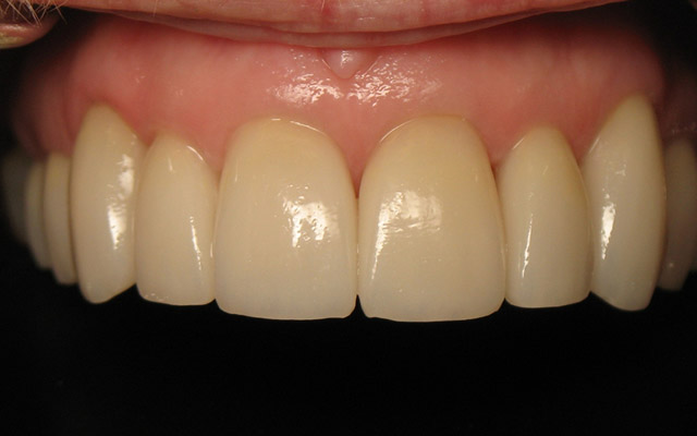 After photo: Porcelain crowns and porcelain veneers