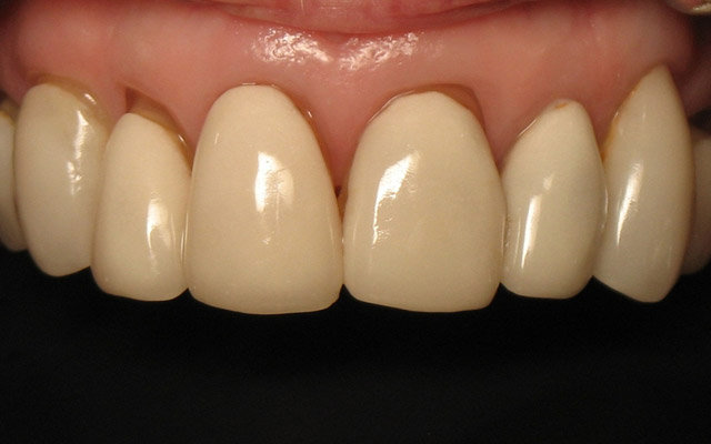 Before photo: Porcelain crowns and porcelain veneers