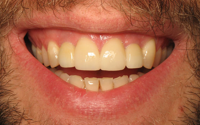 After photo: Dental Implant and veneers
