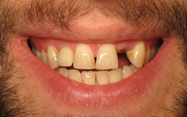 Before photo: Dental Implant and veneers