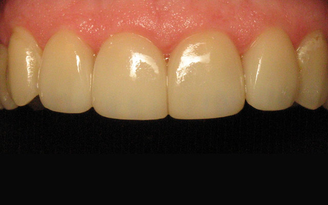 After photo: Porcelain veneers