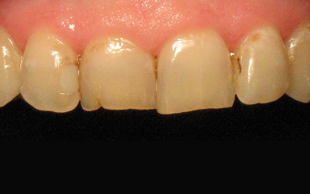 Before photo: Porcelain veneers