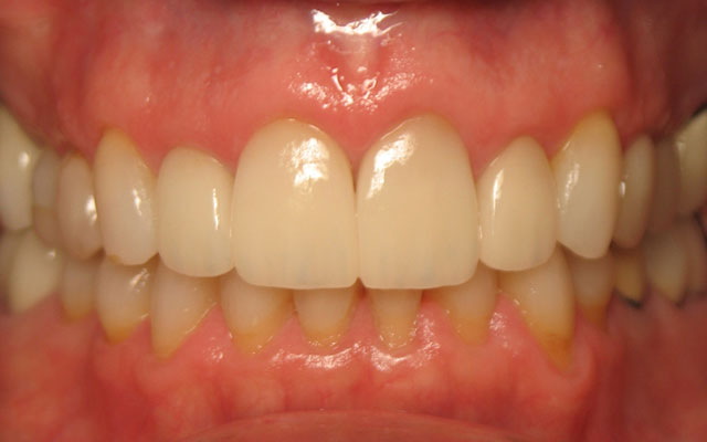 After photo: Porcelain crowns and veneers