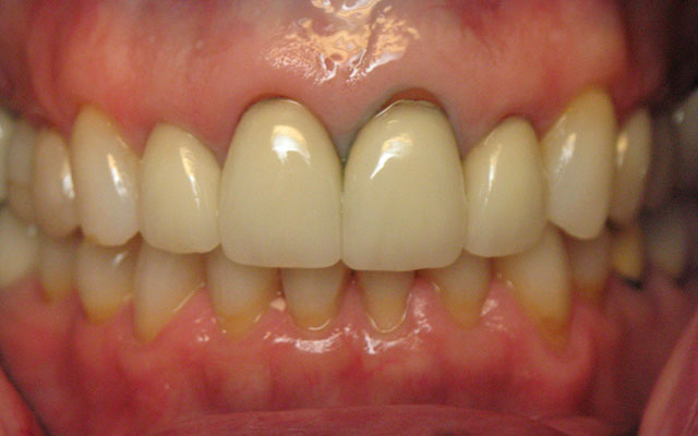 Before photo: Porcelain crowns and veneers