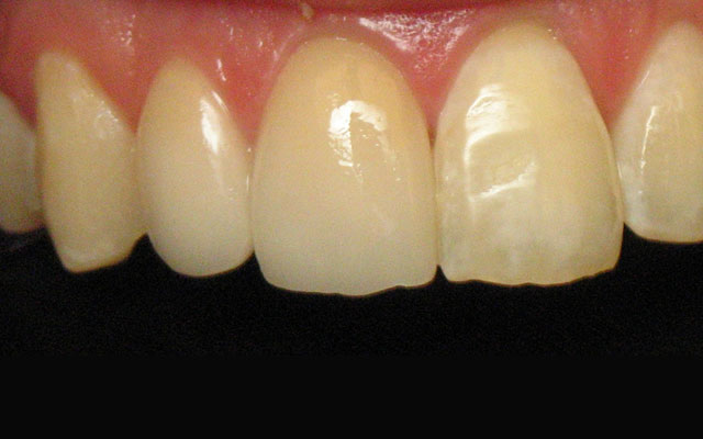 After photo: Porcelain veneers