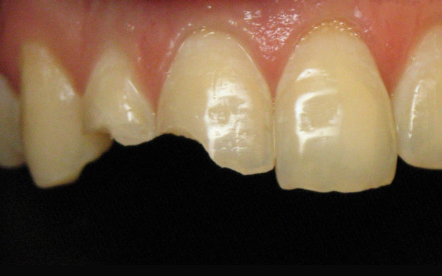 Before photo: Porcelain veneers