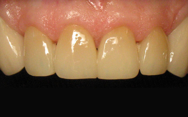 After photo: Porcelain crowns & veneers