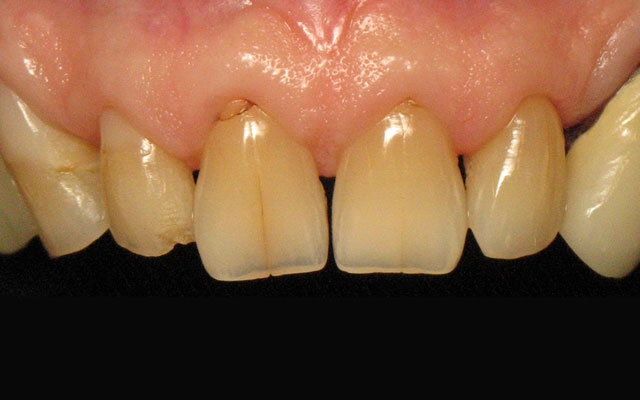 Before photo: Porcelain crowns & veneers