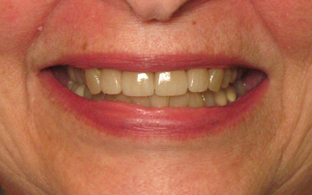 After photo: Porcelain veneers