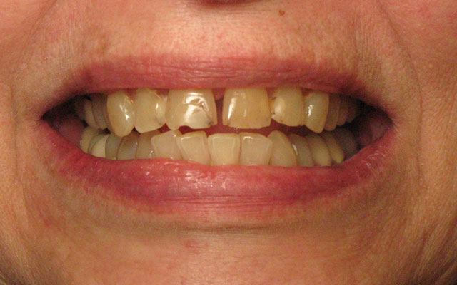 Before photo: Porcelain veneers