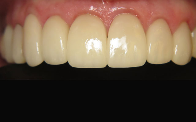 After photo: Porcelain crowns