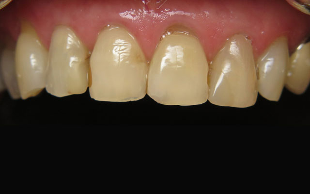 Before photo: Porcelain crowns