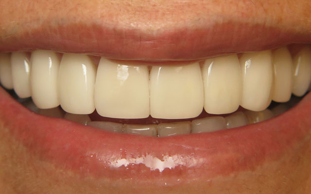 After photo: Porcelain veneers