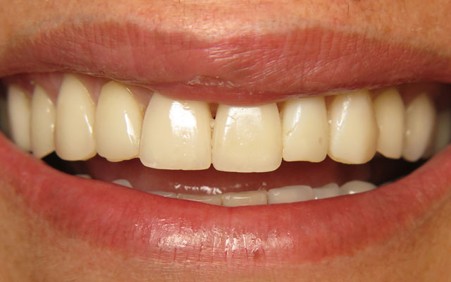 Before photo: Porcelain veneers
