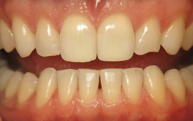 After photo: Porcelain crowns