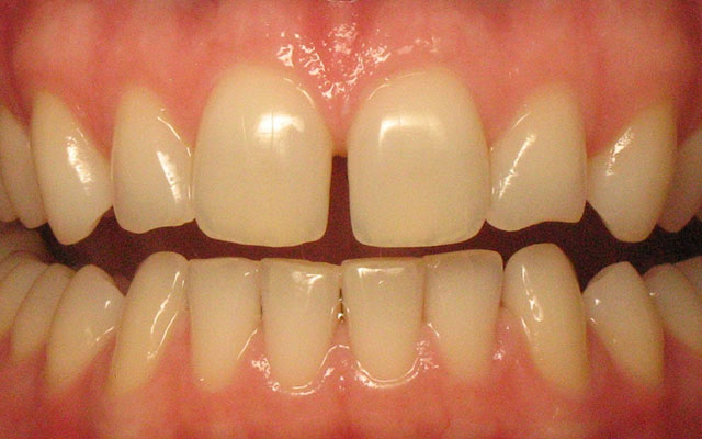 Before photo: Porcelain crowns