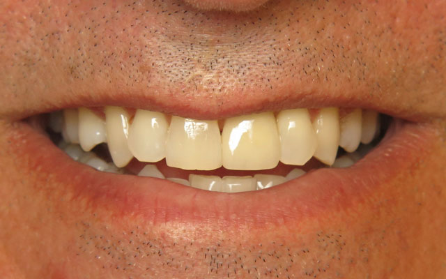 After photo: Dental implant