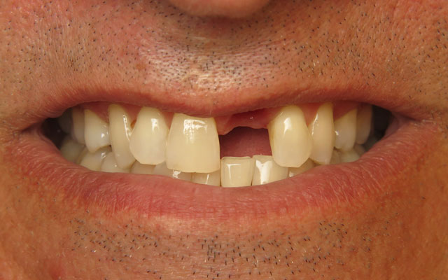 Before photo: Dental implant